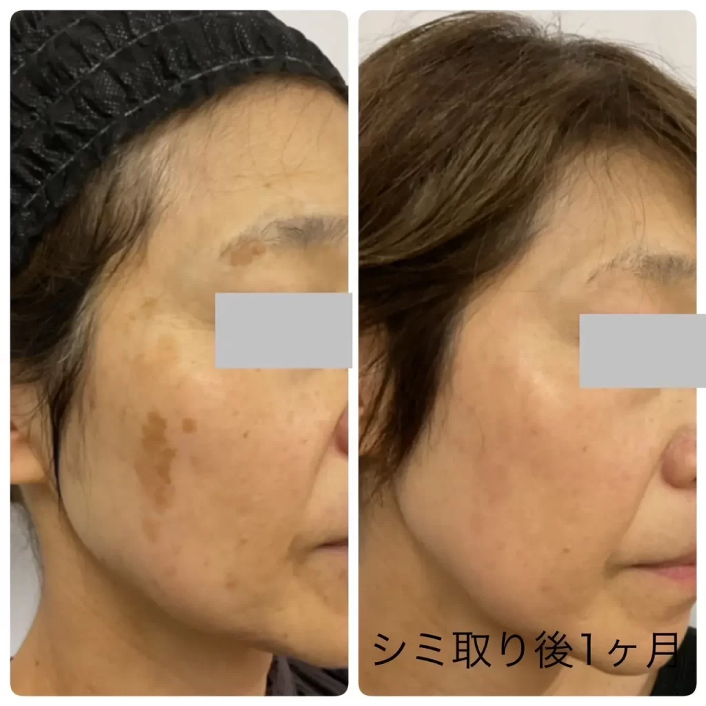 シミ取り治療症例写真