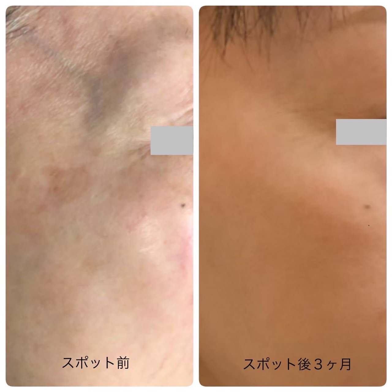 シミ取り（ピコスポット）の症例写真（ビフォーアフター）