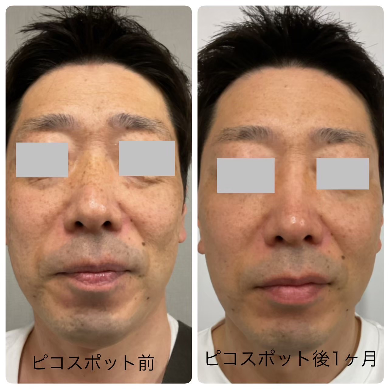 シミ取り（ピコスポット）の症例写真（ビフォーアフター）