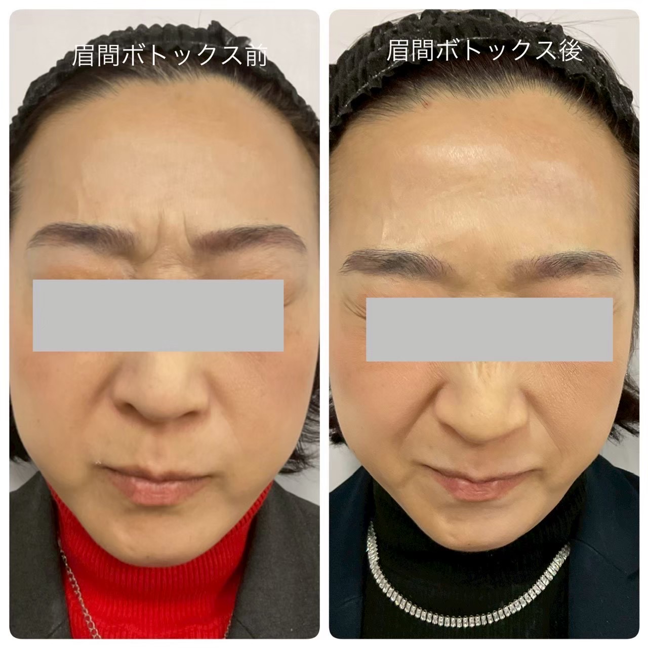 ボツリヌストキシン注射（眉間のしわ）の症例写真（ビフォーアフター）