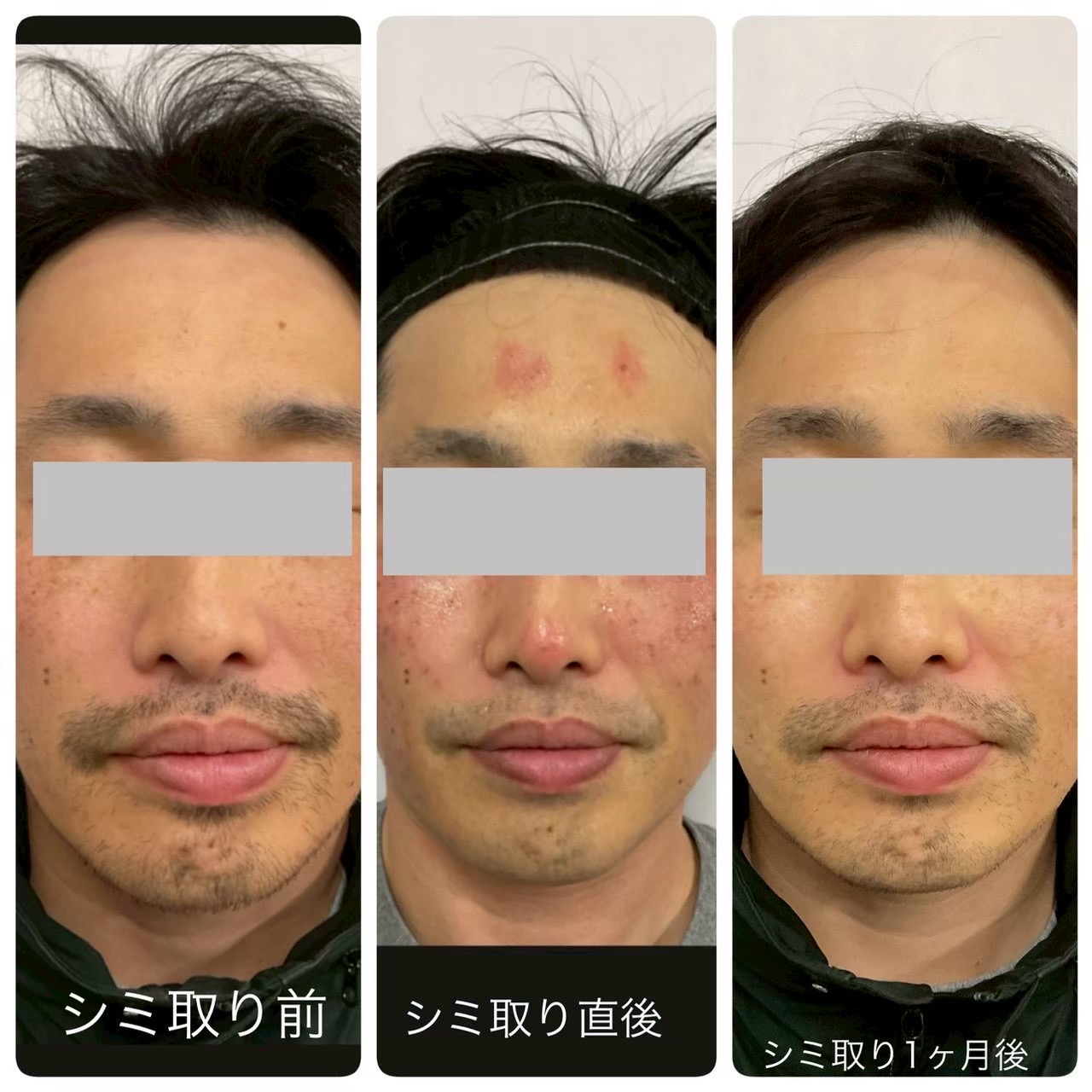 シミ取り（ピコスポット）の症例写真（ビフォーアフター）