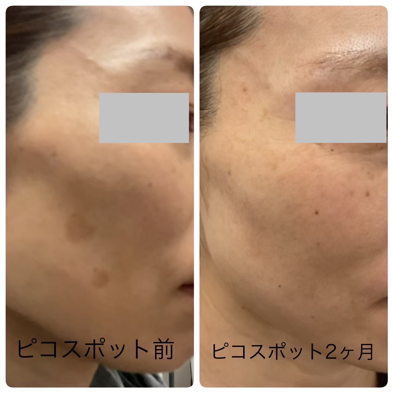 シミ取り（ピコスポット）の症例写真（ビフォーアフター）