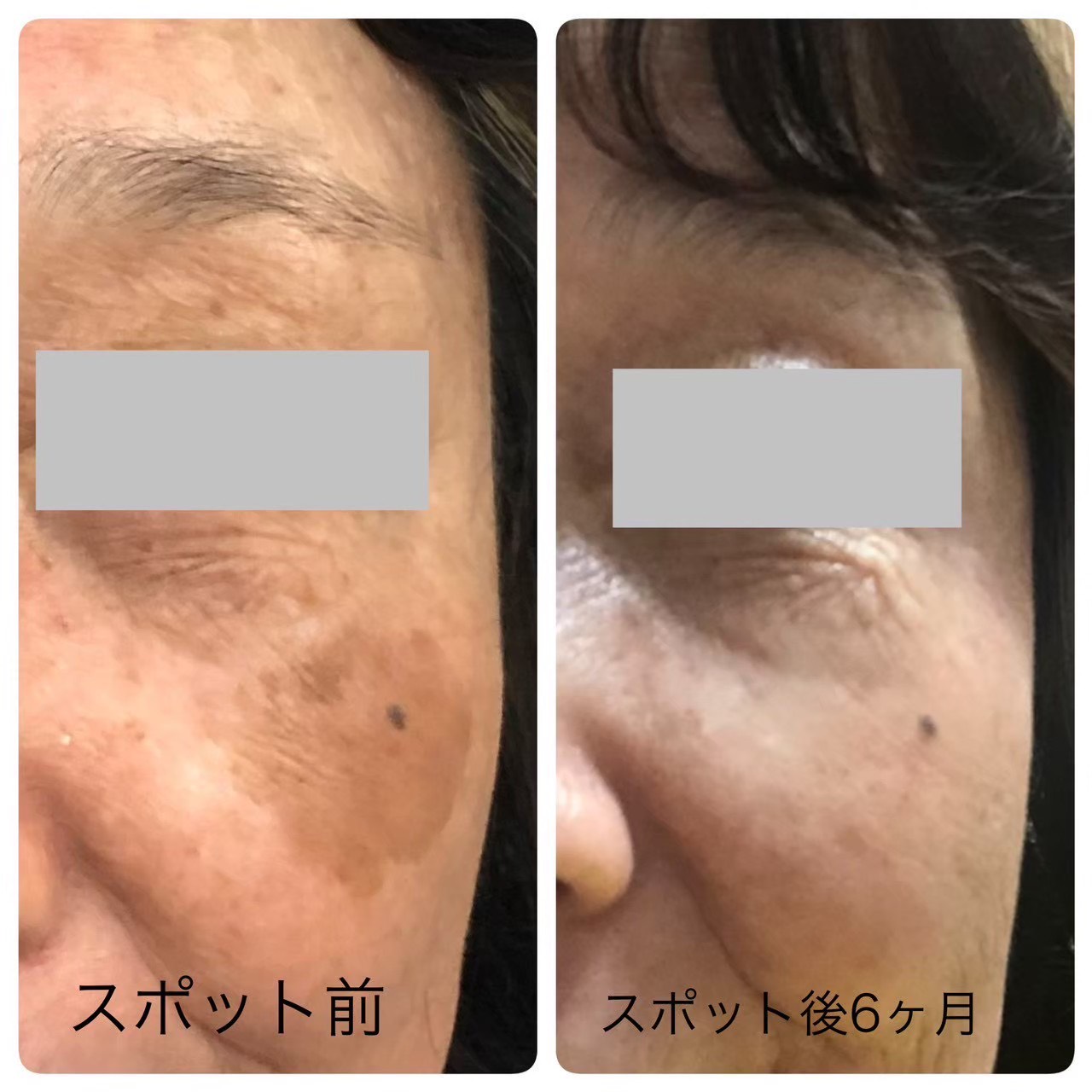 シミ取り（ピコスポット）の症例写真（ビフォーアフター）
